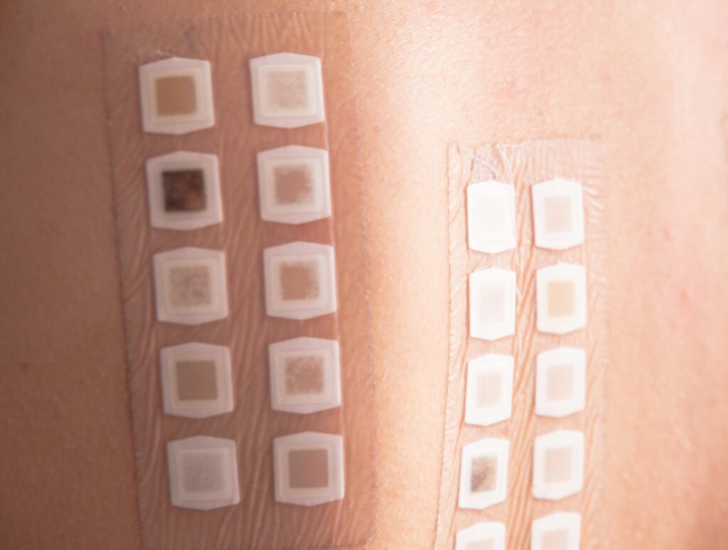 Alergy patch test on the back of a young woman